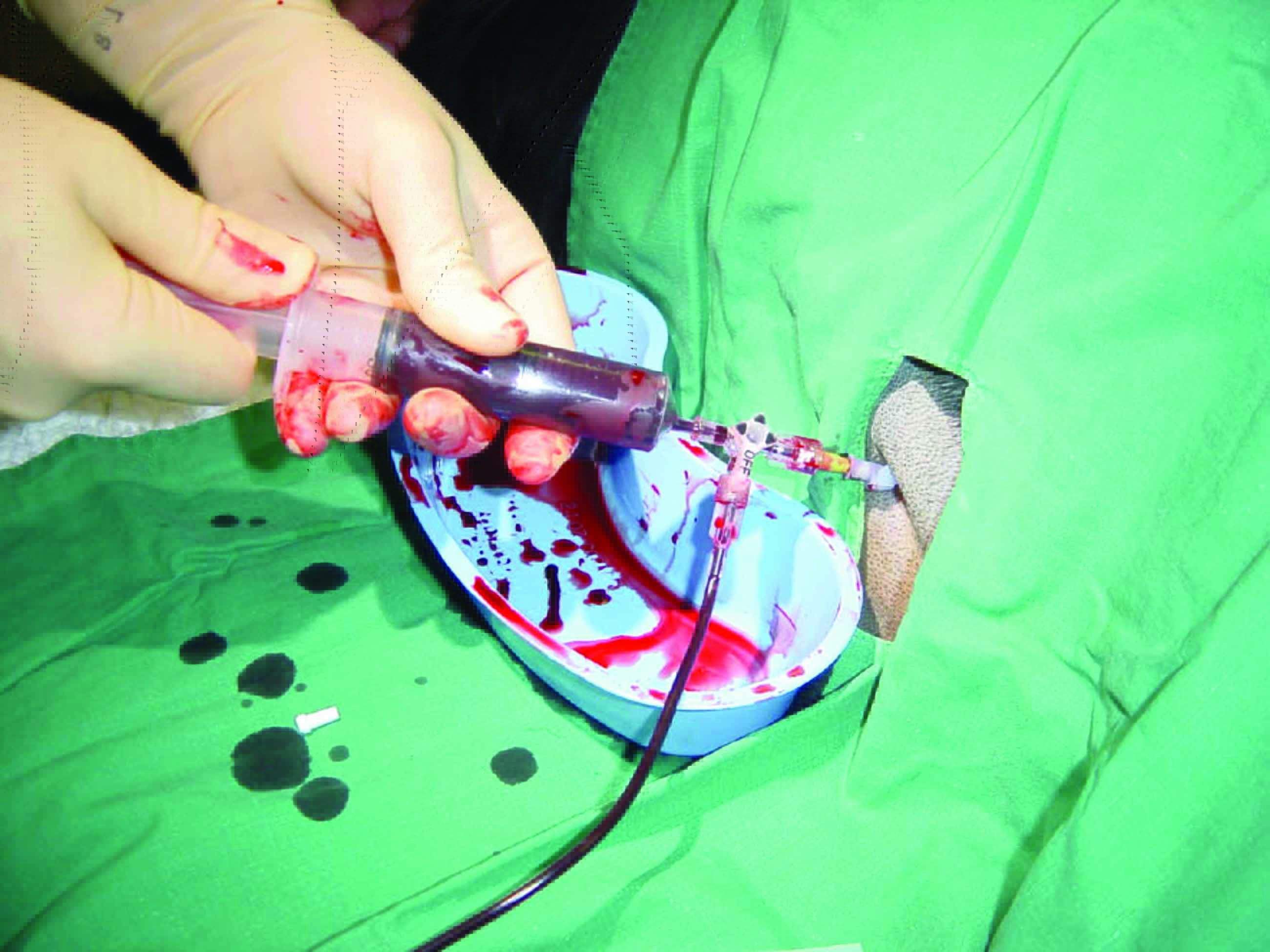pericardiocentesis performed using a pre-fenestrated soft catheter