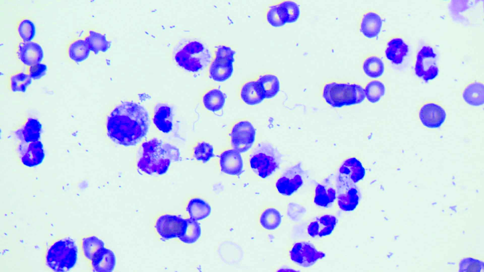 Cytology of the fluid shows the presence of intracellular bacteria 