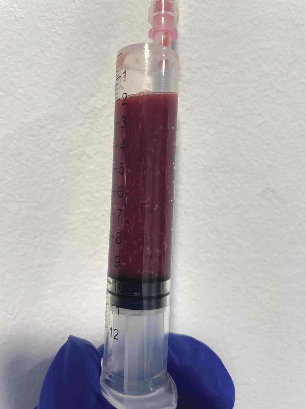 Sample obtained by abdominocentesis in a patient with septic abdomen