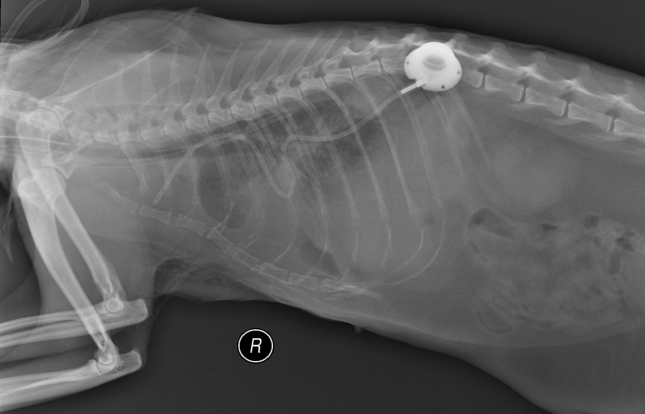 A pleuro-port, as seen on these post-surgery radiographs