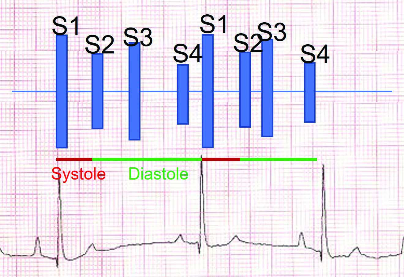 Auscultation of gallop sounds is generally indicative of the presence of diastolic dysfunction