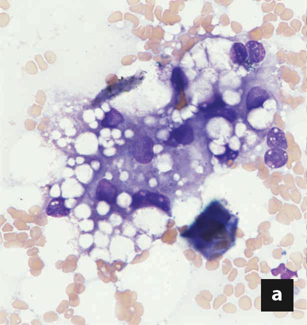 Liver cytology from a cat with hepatic lipidosis