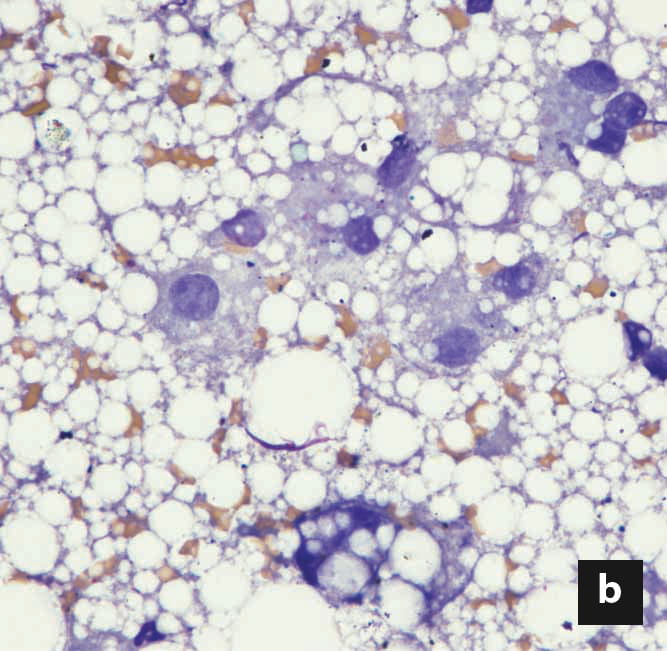 distinct fat vacuoles of varying sizes within the hepatocytes