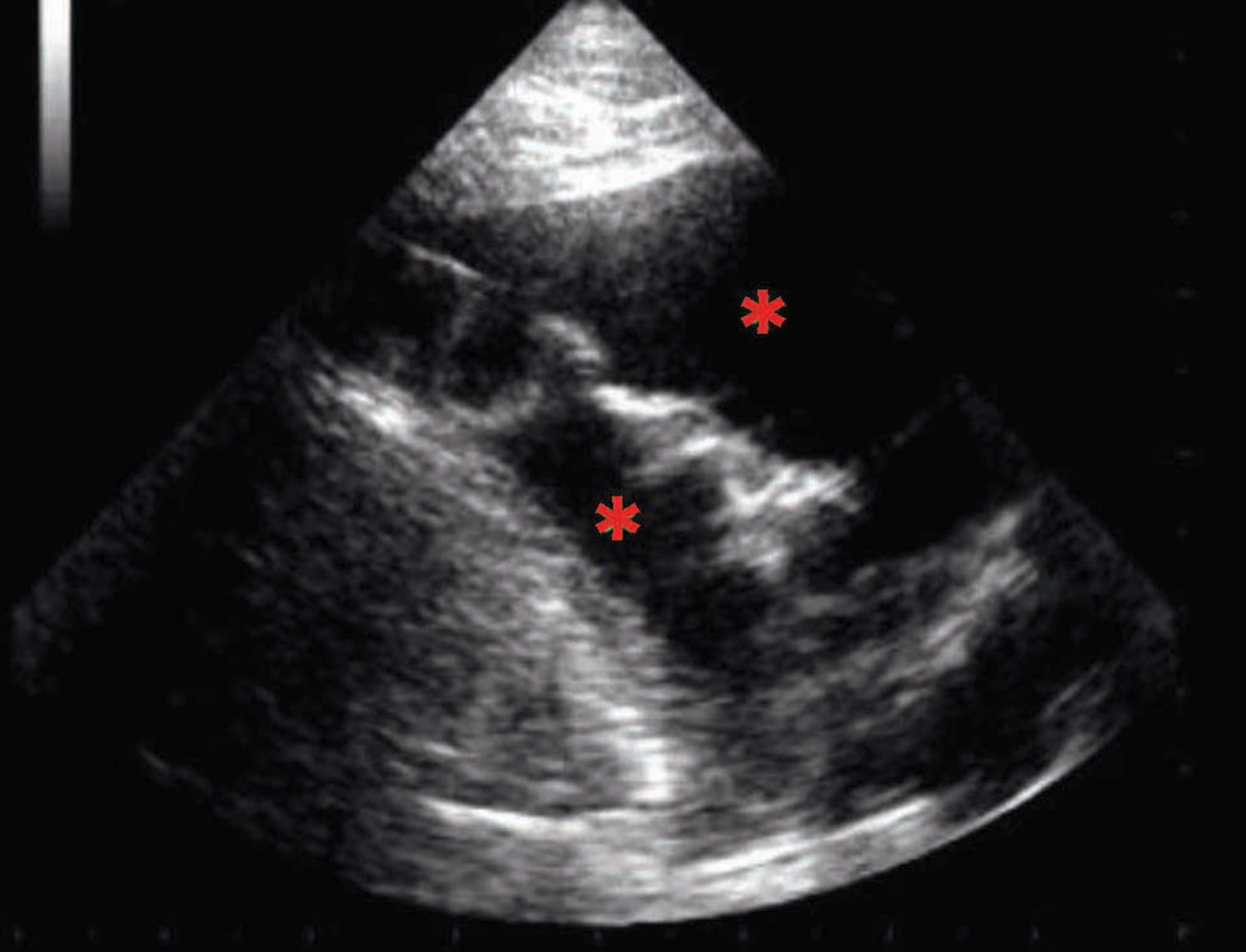 pleural effusion characterized by hypoechoeic areas in the chest cavity 