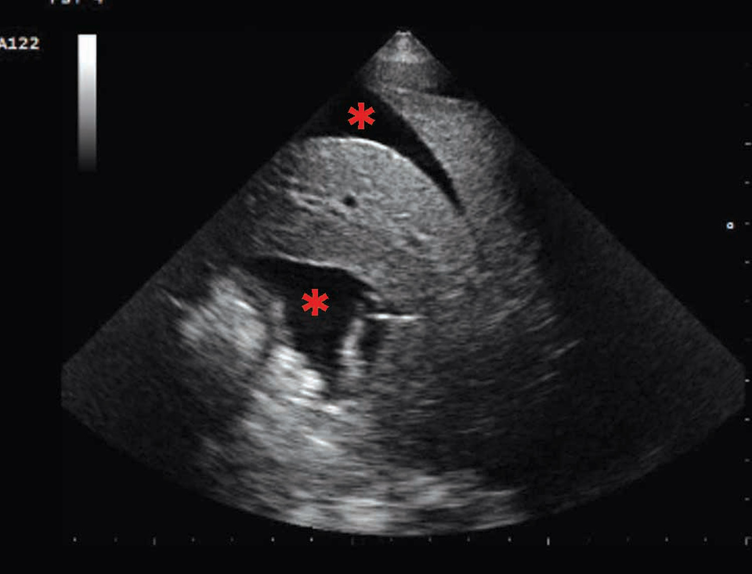 ascites revealed by the presence of a hypoechoeic area in the abdominal cavity 
