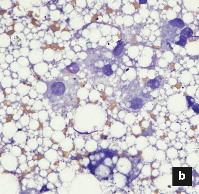 Veterinary procedure showing a liver biopsy being performed on a cat to diagnose hepatic lipidosis.
