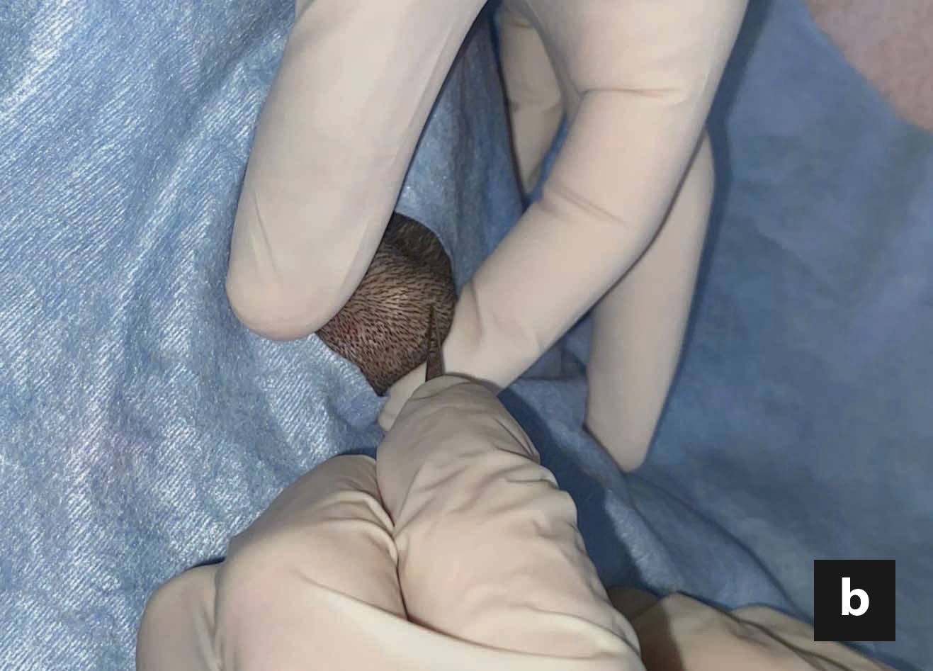 Veterinarian making a small incision over the bulge created by the tip of the forceps during a liver biopsy on a cat to diagnose hepatic lipidosis.
